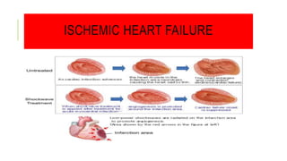 ISCHEMIC HEART FAILURE
 