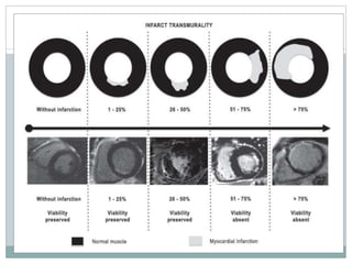 Stemi 3d Stemi | PPTX