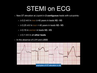 STEMI on ECG
• New ST elevation at J-point in 2 contiguous leads with cut-points:
• ≥ 0.2 mV in men ≥ 40 years in leads V2 - V3
• ≥ 0.25 mV in men < 40 years in leads V2 - V3
• ≥ 0.15 in women in leads V2 - V3
• ≥ 0.1 mV in all other leads
• In the absence of LVH and LBBB
examples of ST-elevation in MI
 