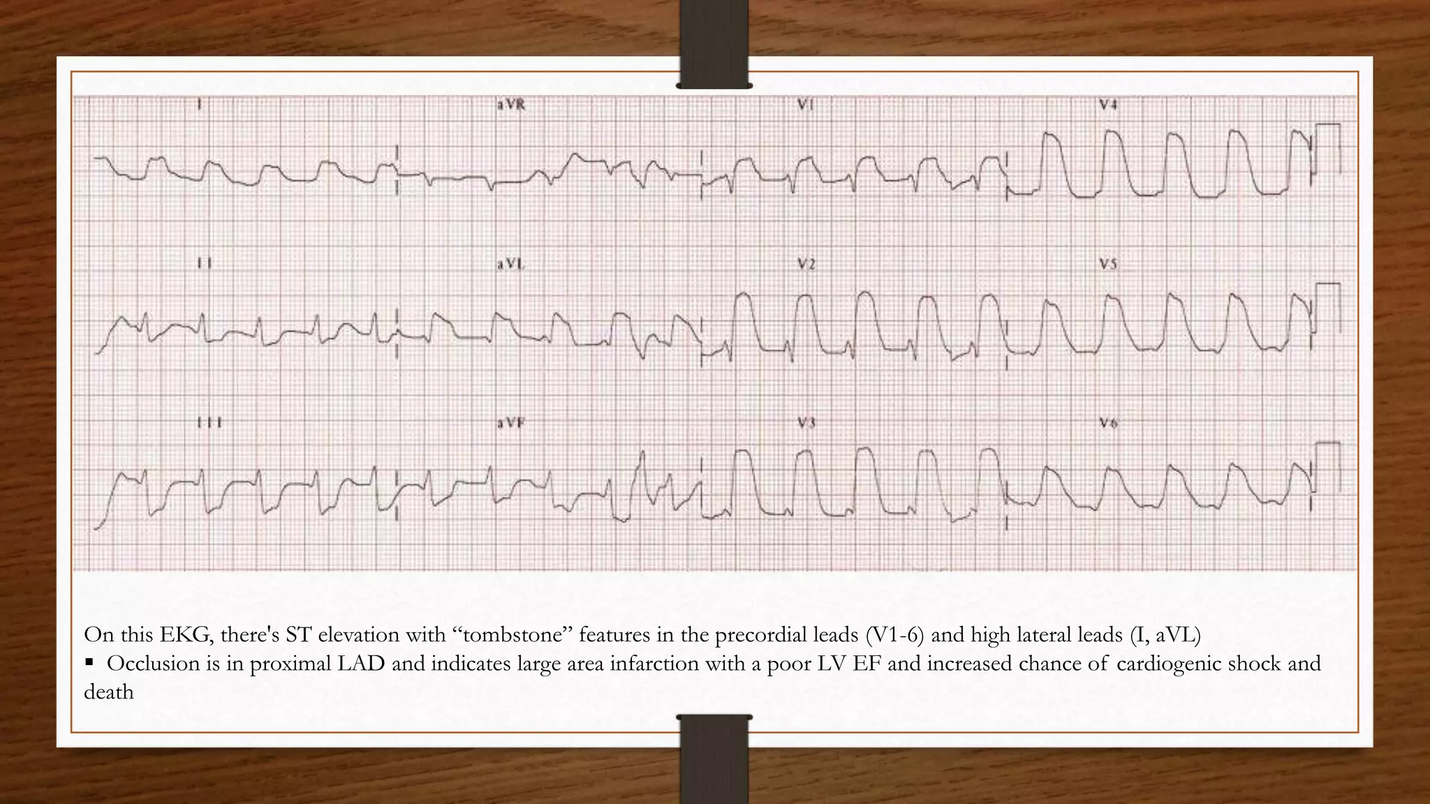 ST elevation myocardial infarction ECG signs 2 | PPTX