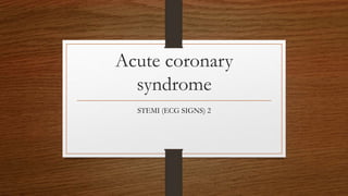 ST elevation myocardial infarction ECG signs 2 | PPTX