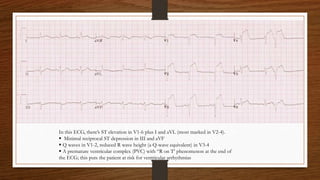 In this ECG, there’s ST elevation in V1-6 plus I and aVL (most marked in V2-4).
 Minimal reciprocal ST depression in III and aVF
 Q waves in V1-2, reduced R wave height (a Q-wave equivalent) in V3-4
 A premature ventricular complex (PVC) with “R on T’ phenomenon at the end of
the ECG; this puts the patient at risk for ventricular arrhythmias
 