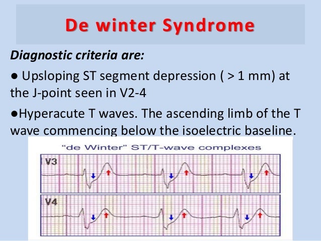 rbbb ecg