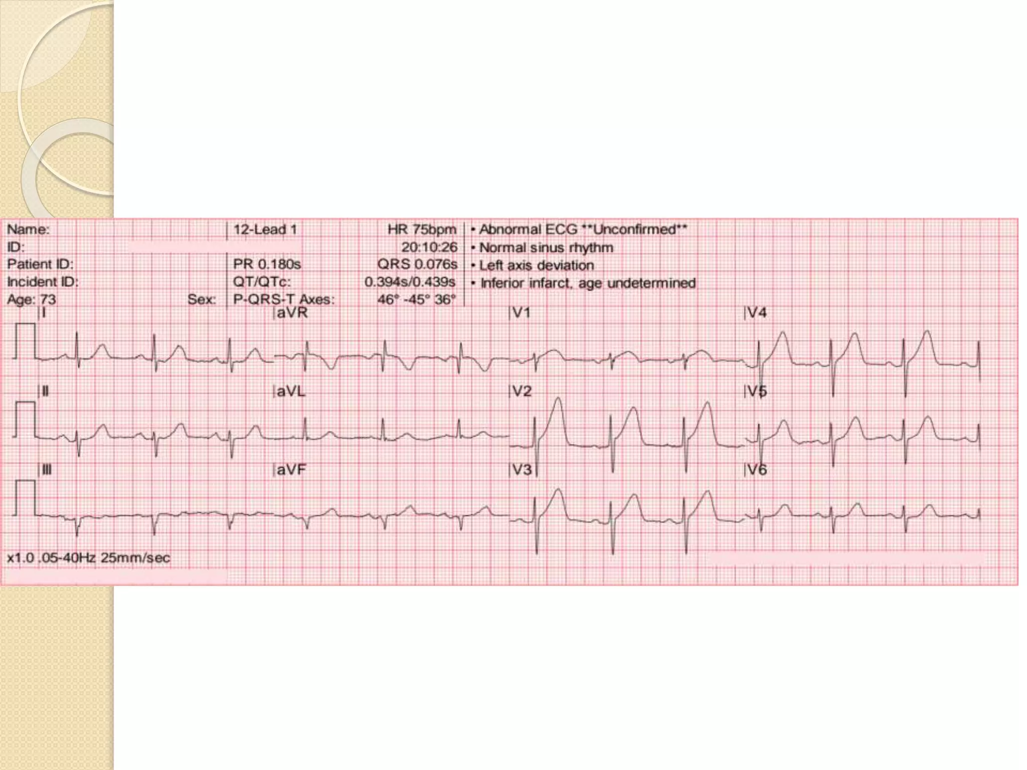 STEMI equivalents- ECG update | PPTX