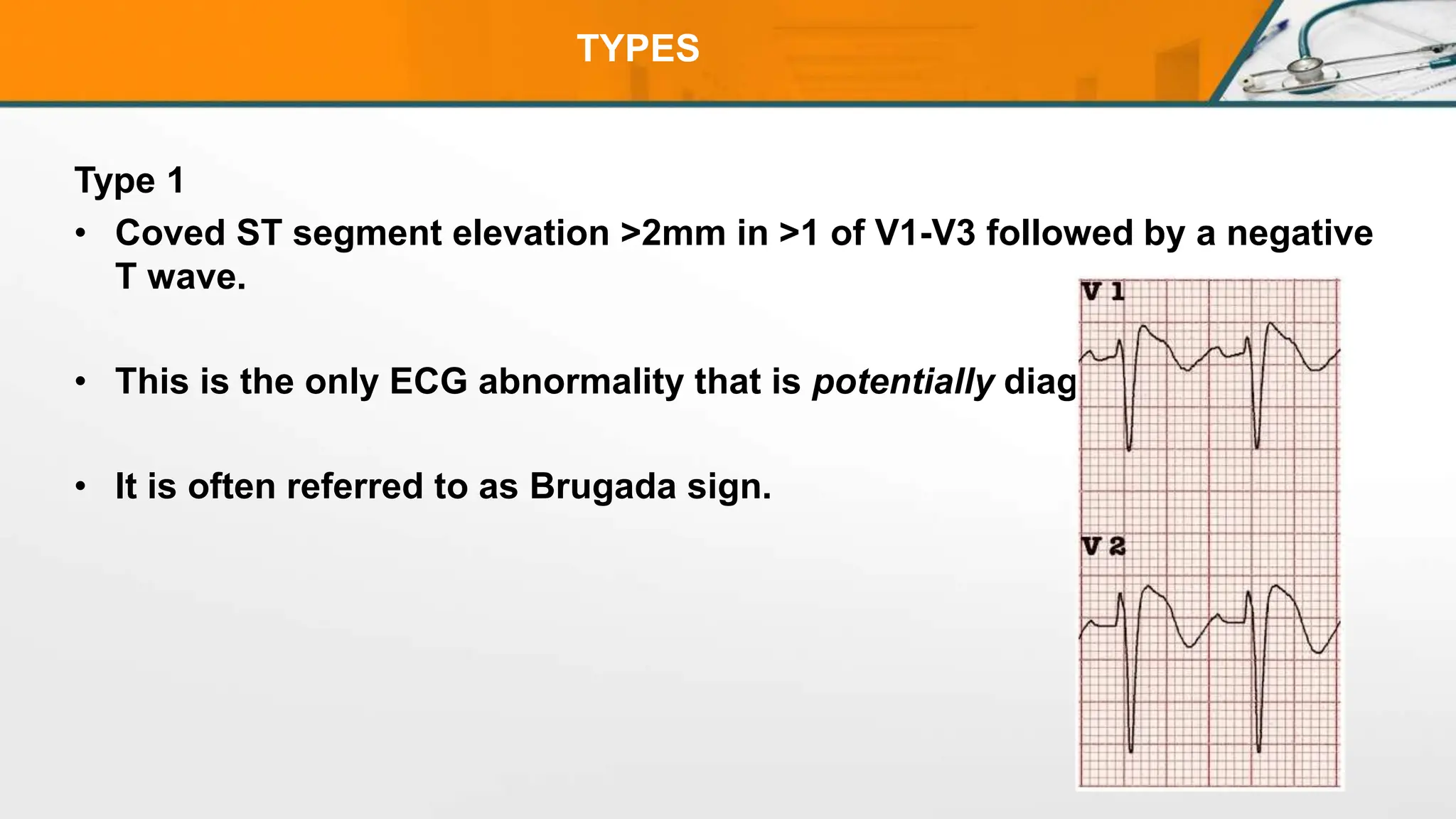 TYPES
Type 1
• Coved ST segment elevation >2mm in >1 of V1-V3 followed by a negative
T wave.
• This is the only ECG abnormality that is potentially diagnostic.
• It is often referred to as Brugada sign.
 