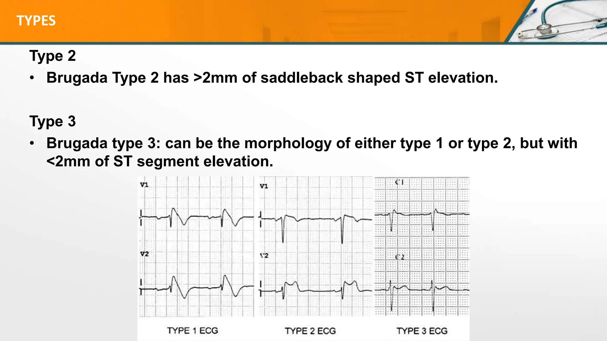 TYPES
Type 2
• Brugada Type 2 has >2mm of saddleback shaped ST elevation.
Type 3
• Brugada type 3: can be the morphology of either type 1 or type 2, but with
<2mm of ST segment elevation.
 