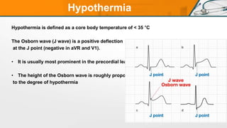 STEMI Mimic WHAT IS IT AND HOW TO IDENTIFY IT ? | PPTX