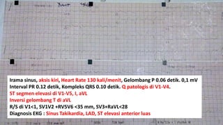 Irama sinus, aksis kiri, Heart Rate 130 kali/menit, Gelombang P 0.06 detik. 0,1 mV
Interval PR 0.12 detik, Kompleks QRS 0.10 detik. Q patologis di V1-V4.
ST segmen elevasi di V1-V5, I, aVL
Inversi gelombang T di aVL
R/S di V1<1, SV1V2 +RV5V6 <35 mm, SV3+RaVL<28
Diagnosis EKG : Sinus Takikardia, LAD, ST elevasi anterior luas

 