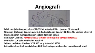 Angiografi

Telah menjalani angiografi ai. CAD STEMI anterior Killip I dengan FR merokok
Tindakan dilakukan dengan pungsi A. Radialis kanan dengan DC Tig 4 5Fr kontras Ultravisk
Hasil angiografi memperlihatkan sistem dominan kanan
Pembuluh LM baik. Pembuluh LAD tampak trombus mid sampai distal LAD
Pembuluh LCX baik. Pembuluh RCA baik
Selama tindakan diberikan NTG 500 mcg, Heparin 2500U
Paksa tindakan tidak ada keluhan, EKG tidak ada perubahan dan hemodinamik stabil

 