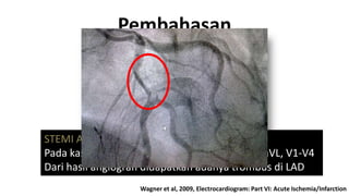 Pembahasan

STEMI Anterior luas
Pada kasus ini terdapat ST segmen elevasi di I, aVL, V1-V4
Dari hasil angiografi didapatkan adanya trombus di LAD
Wagner et al, 2009, Electrocardiogram: Part VI: Acute Ischemia/Infarction

 