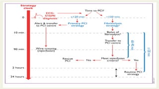 Stemi Process Map STEMI PPT for acute coronary syndome acute MI | PPTX