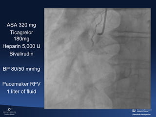ASA 320 mg
Ticagrelor
180mg
Heparin 5,000 U
Bivalirudin
BP 80/50 mmhg
Pacemaker RFV
1 liter of fluid

 