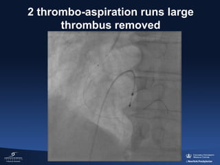 2 thrombo-aspiration runs large 
thrombus removed

 