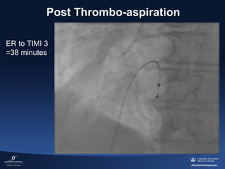 Post Thrombo-aspiration
ER to TIMI 3
=38 minutes

 
