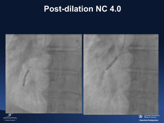 Post-dilation NC 4.0

 