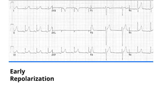 Early
Repolarization
 