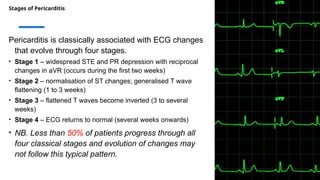 Stages of Pericarditis
Pericarditis is classically associated with ECG changes
that evolve through four stages.
• Stage 1 – widespread STE and PR depression with reciprocal
changes in aVR (occurs during the first two weeks)
• Stage 2 – normalisation of ST changes; generalised T wave
flattening (1 to 3 weeks)
• Stage 3 – flattened T waves become inverted (3 to several
weeks)
• Stage 4 – ECG returns to normal (several weeks onwards)
• NB. Less than 50% of patients progress through all
four classical stages and evolution of changes may
not follow this typical pattern.
 