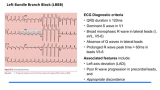Left Bundle Branch Block (LBBB)
ECG Diagnostic criteria
• QRS duration ≥ 120ms
• Dominant S wave in V1
• Broad monophasic R wave in lateral leads (I,
aVL, V5-6)
• Absence of Q waves in lateral leads
• Prolonged R wave peak time > 60ms in
leads V5-6
Associated features include:
• Left axis deviation (LAD);
• Poor R wave progression in precordial leads,
and
• Appropriate discordance
 