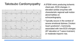 Takotsubo Cardiomyopathy A STEMI mimic producing ischemic
chest pain, ECG changes +/-
elevated cardiac enzymes with
characteristic regional wall motion
abnormalities on
echocardiography.
• Typically occurs in the context of
severe emotional distress (“broken
heart syndrome“). Commonly
associated with new ECG changes
(ST elevation or T wave inversion)
or moderate troponin rise.
 