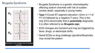 Brugada Syndrome • Brugada Syndrome is a genetic channelopathy
affecting sodium channels with risk of sudden
cardiac death, especially in young males.
• Type 1-Coved ST segment elevation >2mm in >1 of
V1-V3 followed by a negative T wave. This is the
only ECG abnormality that is potentially diagnostic.
It is often referred to as Brugada sign.
• ECG changes are transient and may be triggered by
fever, drugs, or electrolyte shifts.
• Serial ECGs or drug challenge (ajmaline/flecainide)
may reveal the pattern
 