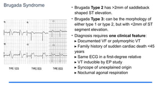 Brugada Syndrome • Brugada Type 2 has >2mm of saddleback
shaped ST elevation.
• Brugada Type 3: can be the morphology of
either type 1 or type 2, but with <2mm of ST
segment elevation.
• Diagnosis requires one clinical feature:
Documented VF or polymorphic VT
▸
Family history of sudden cardiac death <45
▸
years
Same ECG in a first-degree relative
▸
VT inducible by EP study
▸
Syncope of unexplained origin
▸
Nocturnal agonal respiration
▸
 
