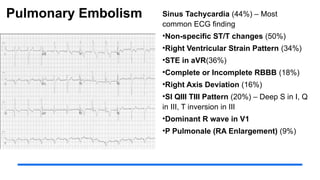 Pulmonary Embolism Sinus Tachycardia (44%) – Most
common ECG finding
•Non-specific ST/T changes (50%)
•Right Ventricular Strain Pattern (34%)
•STE in aVR(36%)
•Complete or Incomplete RBBB (18%)
•Right Axis Deviation (16%)
•SI QIII TIII Pattern (20%) – Deep S in I, Q
in III, T inversion in III
•Dominant R wave in V1
•P Pulmonale (RA Enlargement) (9%)
 