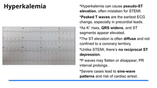 Hyperkalemia •Hyperkalemia can cause pseudo-ST
elevation, often mistaken for STEMI.
•Peaked T waves are the earliest ECG
change, especially in precordial leads.
•As K rises,
⁺ QRS widens, and ST
segments appear elevated.
•The ST elevation is often diffuse and not
confined to a coronary territory.
•Unlike STEMI, there’s no reciprocal ST
depression.
•P waves may flatten or disappear; PR
interval prolongs.
•Severe cases lead to sine-wave
patterns and risk of cardiac arrest.
 