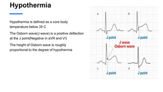 Hypothermia
Hypothermia is defined as a core body
temperature below 35 C
The Osborn wave(J wave) is a positive deflection
at the J point(Negative in aVR and V!)
The height of Osborn wave is roughly
proportional to the degree of hypothermia
 