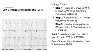Left Ventricular Hypertrophy (LVH)
• Voltage Criteria:
• Step 1: Height of S wave in V1 &
R wave in V5 or V6 >35mm (if
yes, move to Step 2)
• Step 2: R wave in aVL > 11mm (if
yes, move to Step 3)
• Step 3: Look for strain pattern—
ST depression & T wave inversion
in V5 & V6
• If ALL 3 criteria are met, the patient
has LVH with STE (not STEMI)!
• One of these criteria in isolation does
not eliminate STEMI.
 