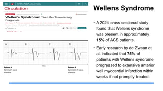 Wellens Syndrome
• A 2024 cross-sectional study
found that Wellens syndrome
was present in approximately
15% of ACS patients.
• Early research by de Zwaan et
al. indicated that 75% of
patients with Wellens syndrome
progressed to extensive anterior
wall myocardial infarction within
weeks if not promptly treated.
 