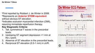 De Winter T Wave
•First reported by Robbert J. de Winter in 2008.
•Represents an Anterior STEMI equivalent
without obvious ST elevation.
•Indicates occlusion myocardial infarction (OMI),
requiring immediate reperfusion therapy.
Key Diagnostic Criteria:
1. Tall, symmetrical T waves in the precordial
leads.
2. Upsloping ST segment depression >1 mm at
the J point.
3. Absence of ST elevation in the precordial leads.
4. Reciprocal ST elevation (0.5-1 mm) in aVR.
 