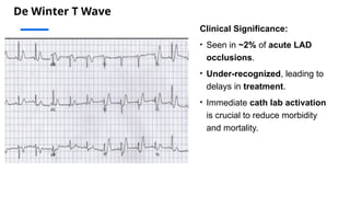 De Winter T Wave
Clinical Significance:
• Seen in ~2% of acute LAD
occlusions.
• Under-recognized, leading to
delays in treatment.
• Immediate cath lab activation
is crucial to reduce morbidity
and mortality.
 