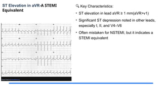 ST Elevation in aVR-A STEMI
Equivalent
🔍 Key Characteristics:
• ST elevation in lead aVR ≥ 1 mm(aVR>v1)
• Significant ST depression noted in other leads,
especially I, II, and V4–V6
• Often mistaken for NSTEMI, but it indicates a
STEMI equivalent
 