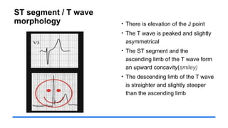 ST segment / T wave
morphology • There is elevation of the J point
• The T wave is peaked and slightly
asymmetrical
• The ST segment and the
ascending limb of the T wave form
an upward concavity(smiley)
• The descending limb of the T wave
is straighter and slightly steeper
than the ascending limb
 