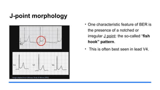 J-point morphology
• One characteristic feature of BER is
the presence of a notched or
irregular J point: the so-called “fish
hook” pattern.
• This is often best seen in lead V4.
 