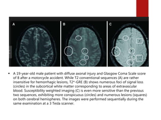 stem cell and Traumatic brain injury | PPTX