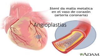 Angioplastias
 