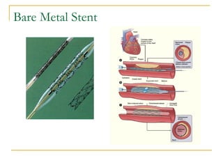 Bare Metal Stent
 