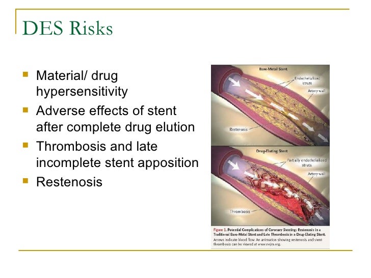 Coronary Stent Design Part B