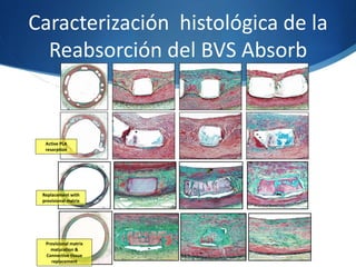 Caracterización histológica de la
Reabsorción del BVS Absorb
Characterization of Absorb BVS Degradation
24 M
36 M
3 M
42 M
Replacement with
provisional matrix
Active PLA
resorption
Provisional matrix
maturation &
Connective tissue
replacement Otsuka et al., CIRCCVINT 2014
 