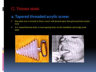 12. Trismus stents
a.Tapered threaded acrylic screw:
 base plate wax is twisted to form a screw with desired taper, then processed into acrylic
resin
 it is turned between teeth, it exert opening force on the mandibule and wedge teeth
apart
 