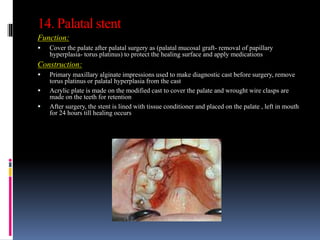 14. Palatal stent
Function:
 Cover the palate after palatal surgery as (palatal mucosal graft- removal of papillary
hyperplasia- torus platinus) to protect the healing surface and apply medications
Construction:
 Primary maxillary alginate impressions used to make diagnostic cast before surgery, remove
torus platinus or palatal hyperplasia from the cast
 Acrylic plate is made on the modified cast to cover the palate and wrought wire clasps are
made on the teeth for retention
 After surgery, the stent is lined with tissue conditioner and placed on the palate , left in mouth
for 24 hours till healing occurs
 