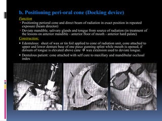 b. Positioning peri-oral cone (Docking device)
Function
 Positioning perioral cone and direct beam of radiation in exact position in repeated
exposure (beam director)
 Deviate mandible, salivary glands and tongue from source of radiation (in treatment of
the lesions on anterior mandible - anterior floor of mouth - anterior hard palate)
Construction:
 Edentulous: sheet of wax or tin foil applied to cone of radiation unit, cone attached to
upper and lower denture base of one piece gunning splint while mouth is opened, if
dorsum of tongue is elevated above cane  wax extension used to deviate tongue.
 Dentulous patient: cone attached with self cure to maxillary and mandibular occlusal
index
 