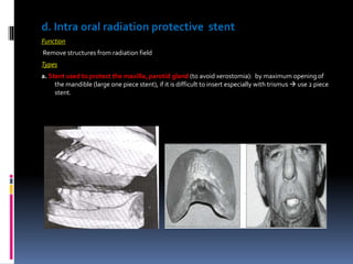 d. Intra oral radiation protective stent
Function
Remove structures from radiation field
Types
a. Stent used to protect the maxilla, parotid gland (to avoid xerostomia): by maximum opening of
the mandible (large one piece stent), if it is difficult to insert especially with trismus  use 2 piece
stent.
 