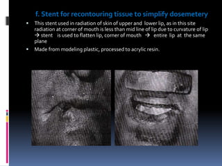 f. Stent for recontouring tissue to simplify dosemetery
 This stent used in radiation of skin of upper and lower lip, as in this site
radiation at corner of mouth is less than mid line of lip due to curvature of lip
 stent is used to flatten lip, corner of mouth  entire lip at the same
plane
 Made from modeling plastic, processed to acrylic resin.
 