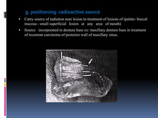 g. positioning radioactive source
 Carry source of radiation near lesion in treatment of lesions of (palate- buccal
mucosa - small superficial lesion at any area of mouth)
 Source incorporated in denture base ex: maxillary denture base in treatment
of recurrent carcinoma of posterior wall of maxillary sinus.
 