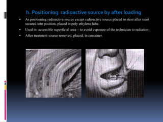 h. Positioning radioactive source by after loading
 As positioning radioactive source except radioactive source placed in stent after stent
secured into position, placed in poly ethylene lube.
 Used in: accessible superficial area – to avoid exposure of the technician to radiation-
 After treatment source removed, placed, in container.
 