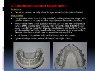 2. Labiolingual (sectioned-hinged) splint:
Indications:
 Dentulous patient- partially edentulous patient- mixed dentition (children)
Construction:
 Composed of 2 buccal section (right and left) and lingual section, hinged wire
connect the buccal sections with the lingual section behind the last molar
 Wax adapted on the labial, buccal and lingual surfaces and not cover occlusal
surface of the teeth (extend to survey line), wire embedded distal to the last
molar tooth form a hinge that allow open and close of splint without fracture,
wire hooks attached to the buccal surface of the appliance for intermaxillary
fixation, blunt button which have undercuts is made at midline
 acrylic button is divided vertically with a fissure bur or with a saw
 tighten wire ligature around the 2 halves of the acrylic button,
 