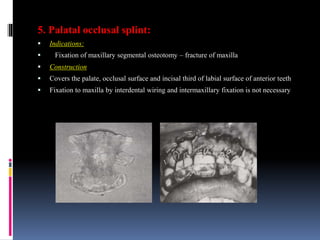 5. Palatal occlusal splint:
 Indications:
 Fixation of maxillary segmental osteotomy – fracture of maxilla
 Construction
 Covers the palate, occlusal surface and incisal third of labial surface of anterior teeth
 Fixation to maxilla by interdental wiring and intermaxillary fixation is not necessary
 