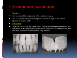 5. Periodontic stent (cosmotic stent)
 Function:
 Hold periodontal dressing in place after periodontal surgery
 Used as cosmotic stent or protective prosthesis to cover exposed root surface
especially in anterior teeth
 Construction:
 Diagnostic cast is waxed up (in the area of surgery- around exposed roots and in the
embrasures), wax is processed into acrylic resin, retention of the stent by friction with
interdental undercut or by wrought wire clasp if needed
 